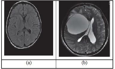 3. METHODOLOGY The recommended methodology contains of a collection of phases begging from grouping brain picture MRI image. The main steps are shown in Figure 1.