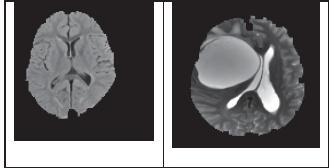 Fuzzy C- Means (FCM) algorithm is used to find out the suspicious area from brain MRI image. This fuzzy c-means clustering method provides good segmentation result. 3.