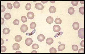 Malaria: Diagnostics Rapid diagnostic test (RDT) Lateral flow
