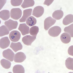 Malaria Caused by a protozoal blood parasite Plasmodium vivax Plasmodium ovale