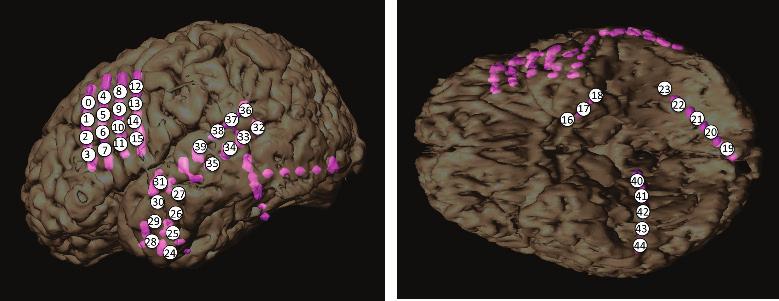 In this paper, we developed a new method of estimation and visualization of epileptic foci and propagation structure of epileptiform discharges.