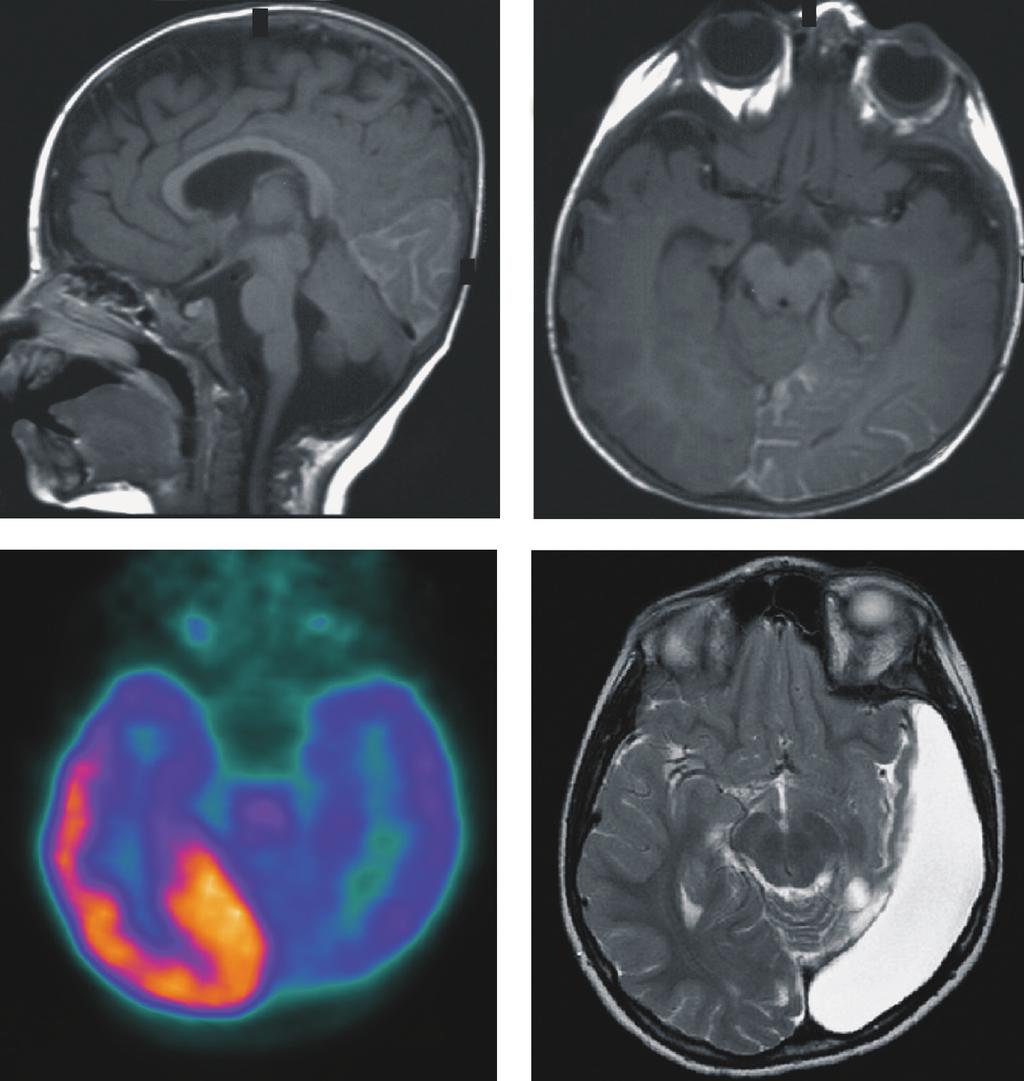Surgery in Sturge-Weber syndrome with generalized seizures A H B A P 3 C D Figure 2. Structural and functional imaging.