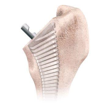 Cancellous Bone Compaction Use the Modular Bone Impactor (L94013) to compact the cancellous bone proximally.