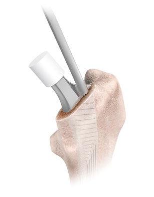 Figure 13 Femoral Head Impaction A final trial reduction is carried out to confirm joint stability and range of motion. A DePuy Synthes 12/14 head must be used.