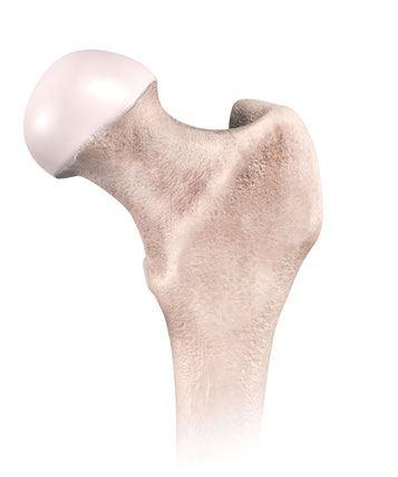 STEP 2: FEMORAL NECK RESECTION The level of the neck cut, defined during the pre-op planning, is achieved using anatomical landmarks (lesser trochanter, trochanteric fossa, greater trochanter) and a