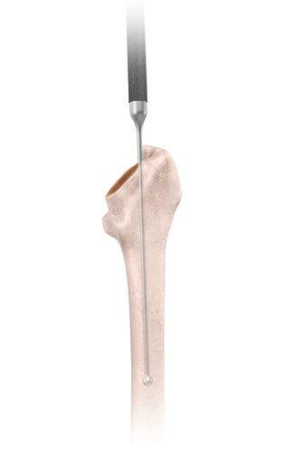 To prevent under-sizing or varus positioning, the greater trochanter may be prepared with a Modular Box Osteotome (2598-07-530) to allow better insertion of the broaches.