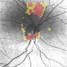 Optic Nerve Optic Nerve Optic Nerve Scan