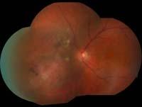 Optic Nerve OCT when the patient isn t dilated?