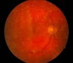 Scanning Laser Ophthalmoscope. JOP. Summer/2007 Vol 29:Supplement p.