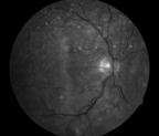 Evaluation of Artifacts Associated with Macular SD OCTssessment of