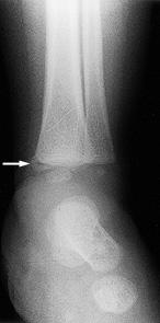 Examples of Abuse-Specific Fractures Companion Patient #2 Companion Patient #3 Companion