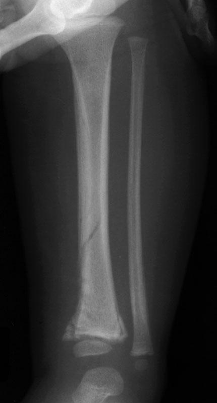 Corner fracture Spiral or Toddler s fracture (not specific for abuse) Metaphyseal fracture