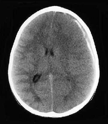 Common Intracranial Findings Subdural hemorrhages (most common)