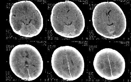 Acute CT Head Images: 3 months