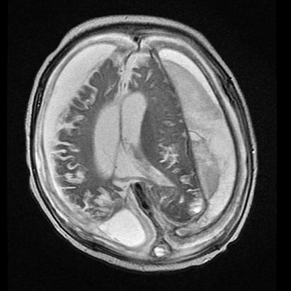 Findings T2 Large bilateral subdural collections Rightward midline shift- mass