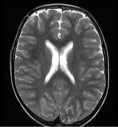 Focal Epilepsies- Epilepsy Syndromes and MRI The site of lesion may be predictive of