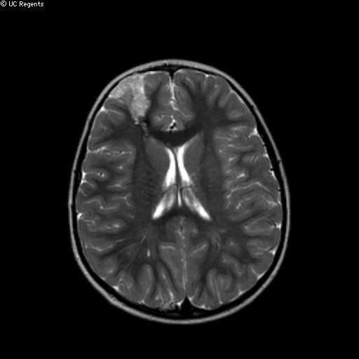 Vascular Malformations: Parameters Predictive of Epilepsy