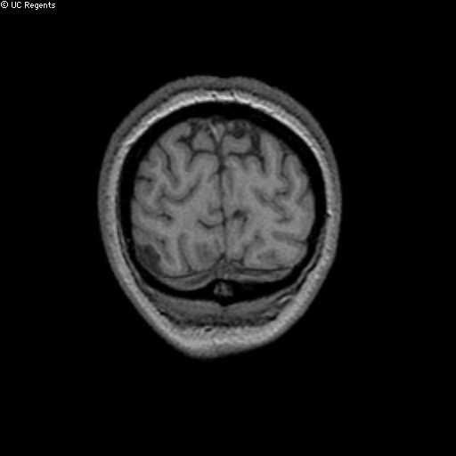 al, AJNR 1995;16:345-350 Causes of Pediatric Epilepsy Brain