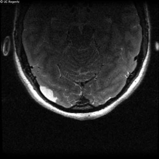 Tumor (DNT) 3T MRI