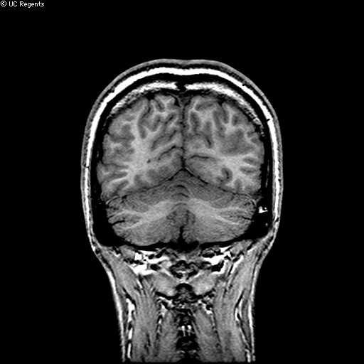 Malformations secondary to abnormal late migration/cortical