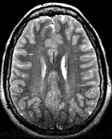 heterotopia outside Layer 1 FCD Type I - Dyslamination of Cerebral