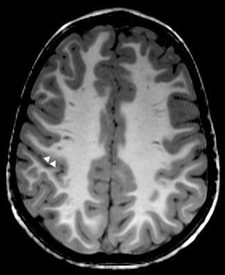 epilepsy Frontal Lobe: Cortical
