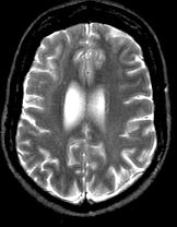 Malformations secondary to abnormal neuronal