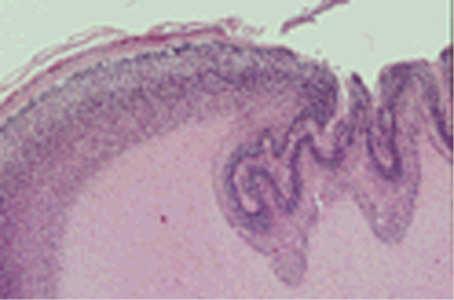 A malformation characterized by multiple small