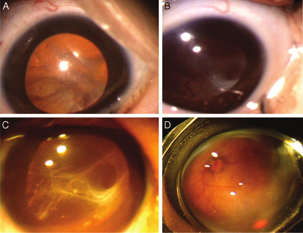 ANTIANGIOGENIC THERAPY FOR ROP QUIROZ-MERCADO ET AL S23 Fig. 1. Case 1. Patient from group I. A, Baseline photograph showing retinal temporal detachment and active neovascularization (arrow).
