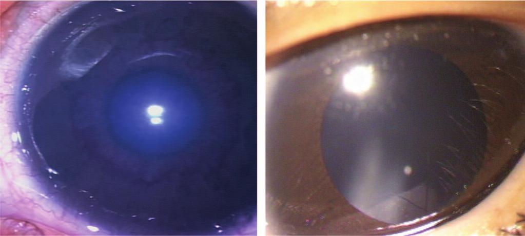 S24 RETINA, THE JOURNAL OF RETINAL AND VITREOUS DISEASES 2008 VOLUME 28 NUMBER 3 Fig. 3. Case 3.