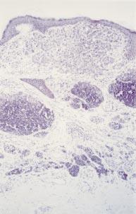 592 Blessing, Grant, Sanders, et al Figure 1 Conventional malignant melanoma. The cells become smaller deep in the lesion, at the base (small melanoma cells), mimicking benign naevus.