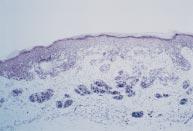 Cells within the dermis are hyperchromatic and nested. Figure 3 Small cell melanoma, as in fig 2.