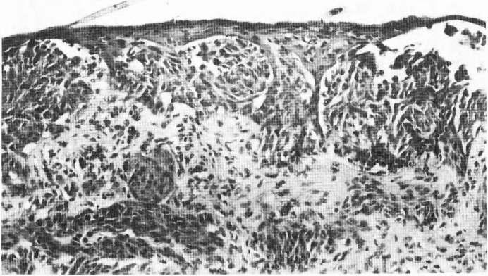 B. Dmitrović i suradnici: Desmoplastic malignant melanoma. Med Vjesn 1991; 23(1-2) 45-49 46 FIGURE 1. Biopsy of the primary lesion. Atypical melanocytes are pre sent near the edges of ulceration.