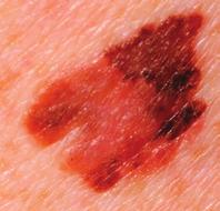Severely atypical moles/melanoma in situ.
