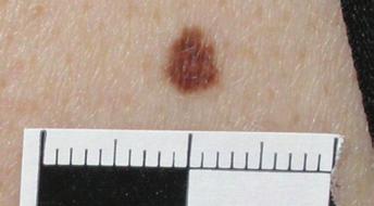 The risk of melanoma from any such mole is extremely low but