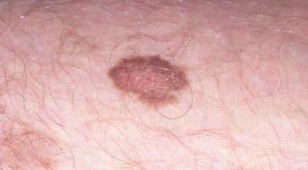 These moles have an extremely low risk of change and should
