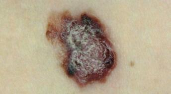 The prevention, diagnosis, referral and management of melanoma of