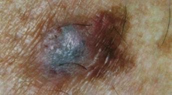 Superficial spreading melanoma: showing irregularity of shape and