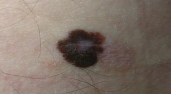 Melanomas tend to have several different colours: browns, blacks,