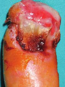 The growth rate of the precursor lesion is very slow but once invasive