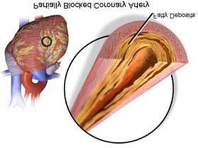 Coronary Angioplasty WHAT YOU SHOULD KNOW: Coronary Angioplasty (AN-g-o-plas-tee) is a procedure to open one or more small arteries in your heart. It is also called a "PTI" or "PCI".