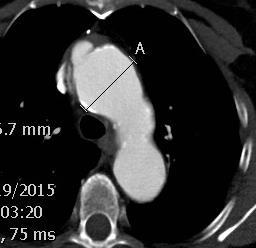 replacement CAD with positive NST COPD with emphysema Referred by