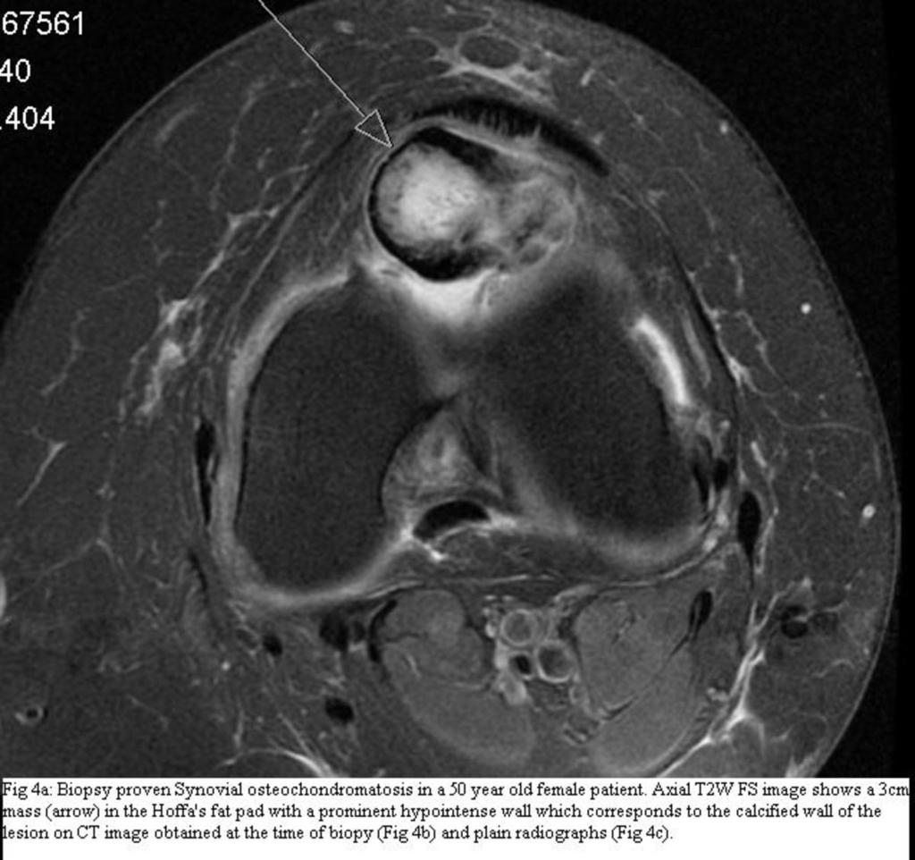 On plain radiograph findings the synovial chondromatosis pathognomically appears as multiple intraarticular calcified nodules that are characteristically uniform in size.