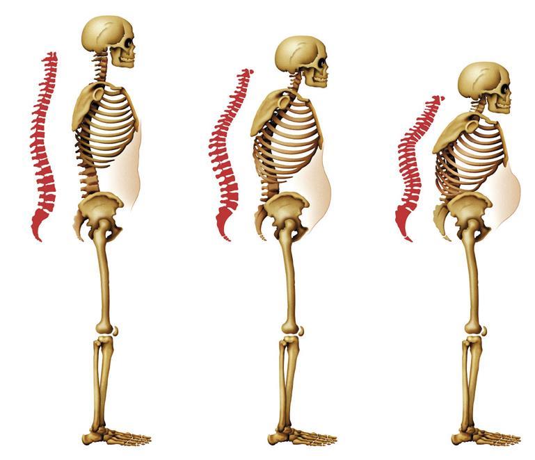 Spinal Fractures can result in: height loss back pain sleep disturbance impaired