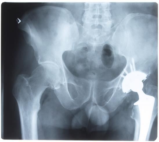 HIP FRACTURES: 40% who fracture a hip had a prior (non-hip)
