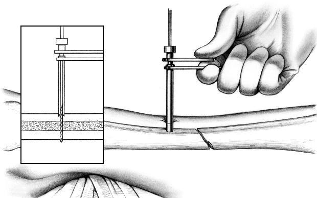 After bi-cortical penetration of the drill, the drill and drill guide are withdrawn.