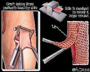 Skin Graft - A skin graft is a surgical procedure