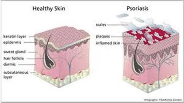 Na okončinah se pojavijo plaki kože, ki se lušči.