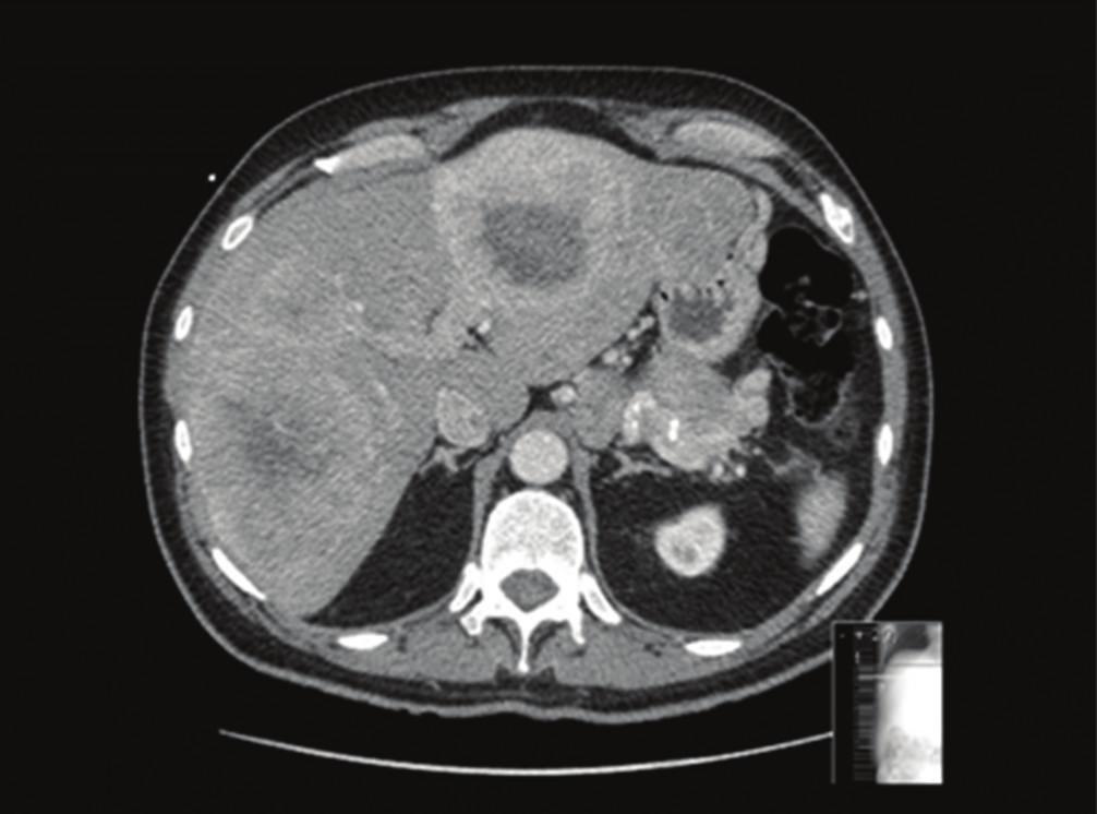 2 International Journal of Hepatology (a) (b) Figure 1: CT of bilobar hepatic metastases from a malignant NET in the (a) arterial phase and (b) venous phase.