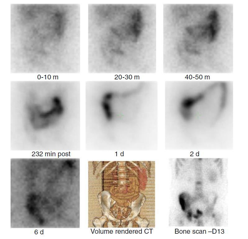 Imaging of 223 RaCl 2 Small bowel Colon No